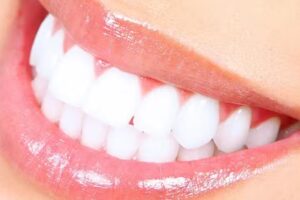 White Smile &ndash; Blanqueamiento dental